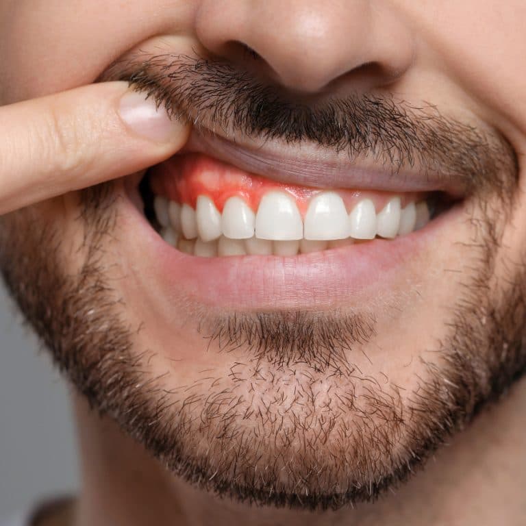 Swollen cheek and dental abscess: when it's urgent